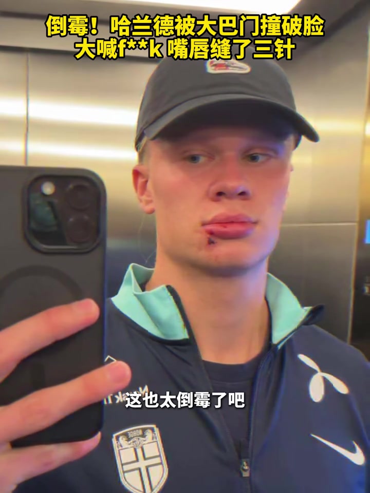 嘴角縫了三針哈蘭德被大巴車門撞破臉現(xiàn)場大喊Fxxk