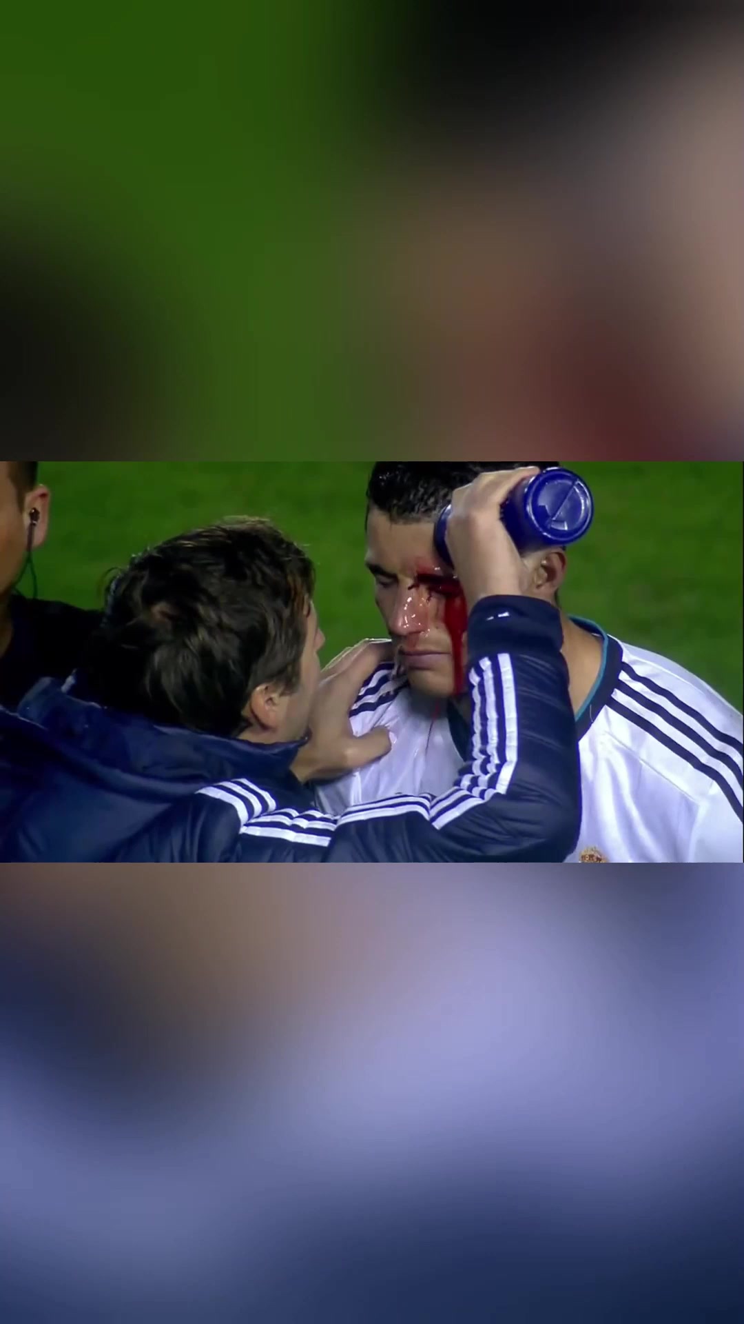 硬漢C羅眉骨破裂現(xiàn)場(chǎng)縫針單眼進(jìn)球霸氣回?fù)魧?duì)手